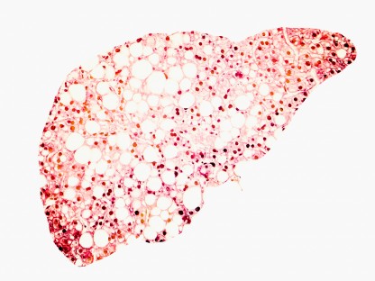 Fettleber - NAFLD & NASH