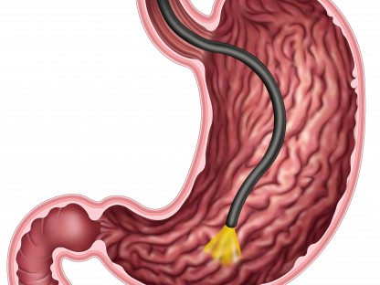 Magenspiegelung - Gastroskopie