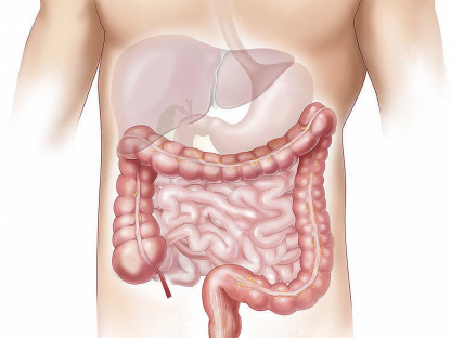 Morbus Crohn & Colitis ulcerosa